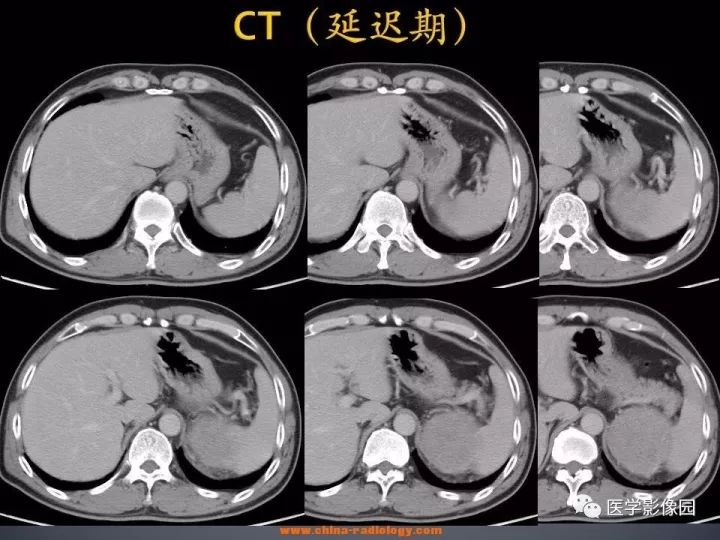 【病例】肾上腺嗜酸细胞腺瘤1例CT影像表现