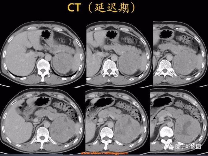 【病例】肾上腺嗜酸细胞腺瘤1例CT影像表现