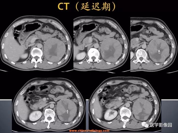 【病例】肾上腺嗜酸细胞腺瘤1例CT影像表现