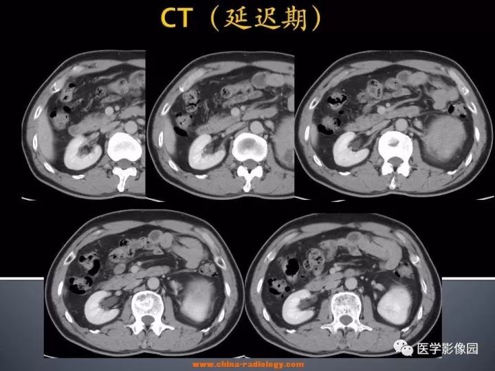 【病例】肾上腺嗜酸细胞腺瘤1例CT影像表现