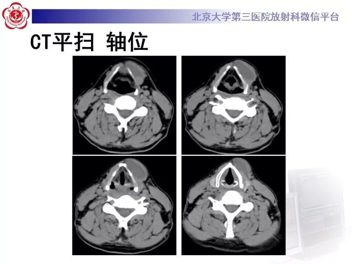 【病例】颈部囊性病例3例