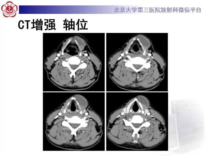 【病例】颈部囊性病例3例