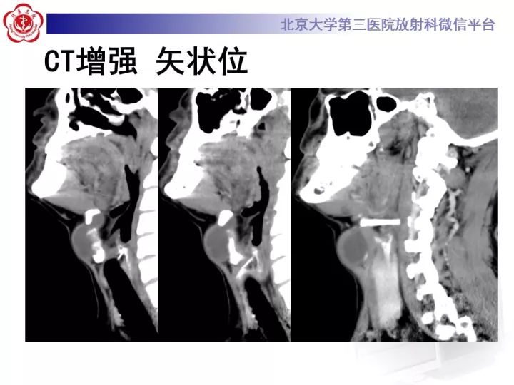【病例】颈部囊性病例3例