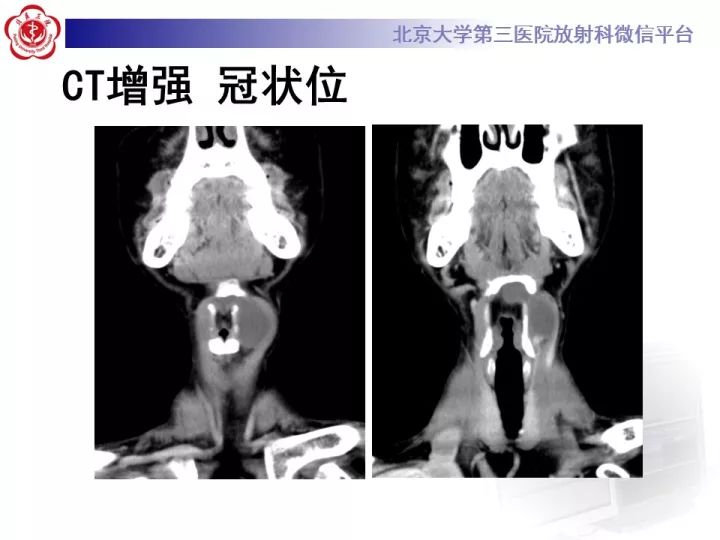 【病例】颈部囊性病例3例