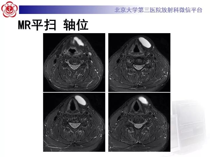 【病例】颈部囊性病例3例