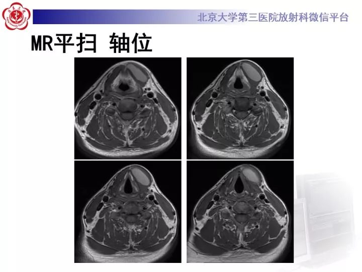 【病例】颈部囊性病例3例