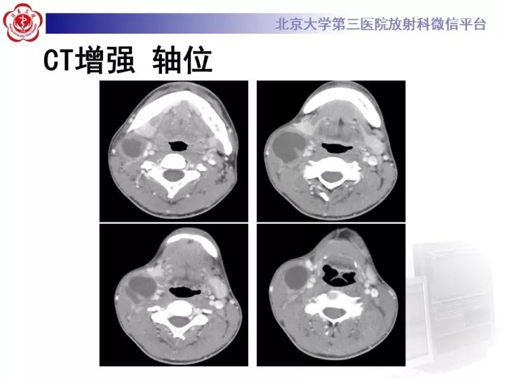 【病例】颈部囊性病例3例
