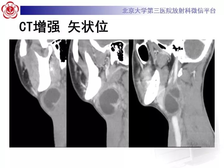 【病例】颈部囊性病例3例