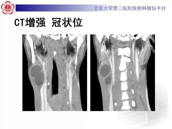 【病例】颈部囊性病例3例