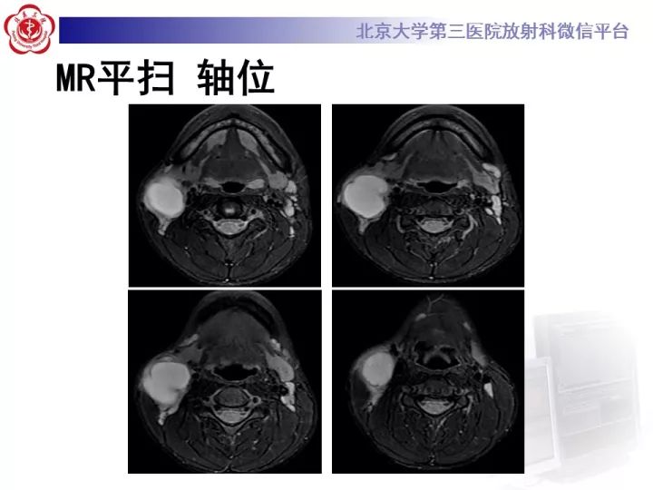 【病例】颈部囊性病例3例