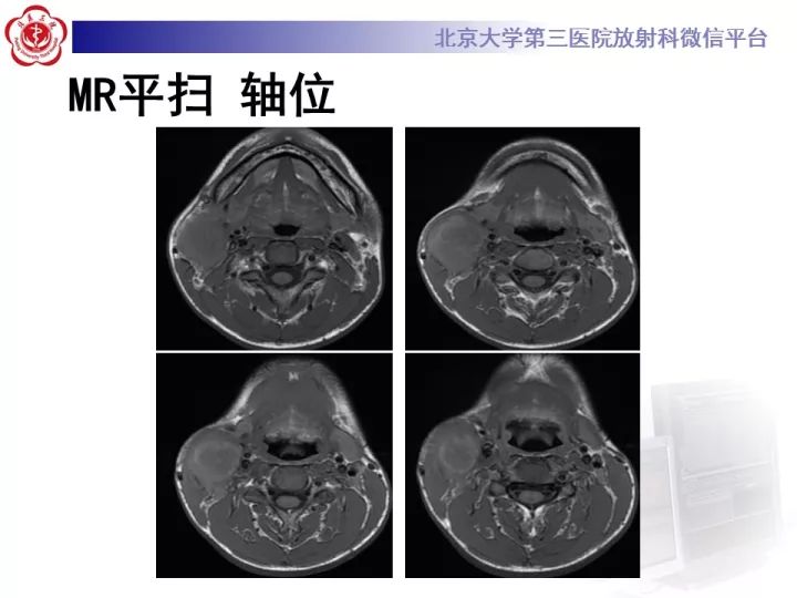 【病例】颈部囊性病例3例