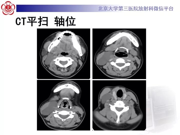 【病例】颈部囊性病例3例