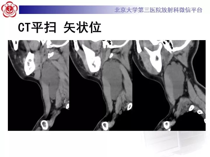 【病例】颈部囊性病例3例
