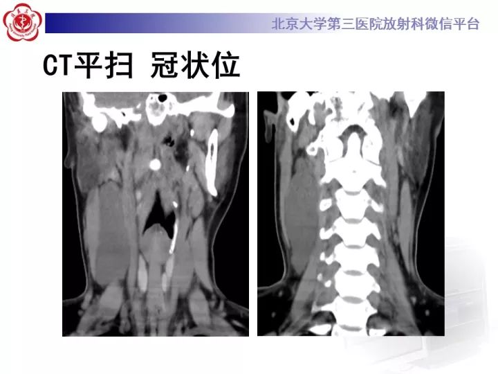 【病例】颈部囊性病例3例