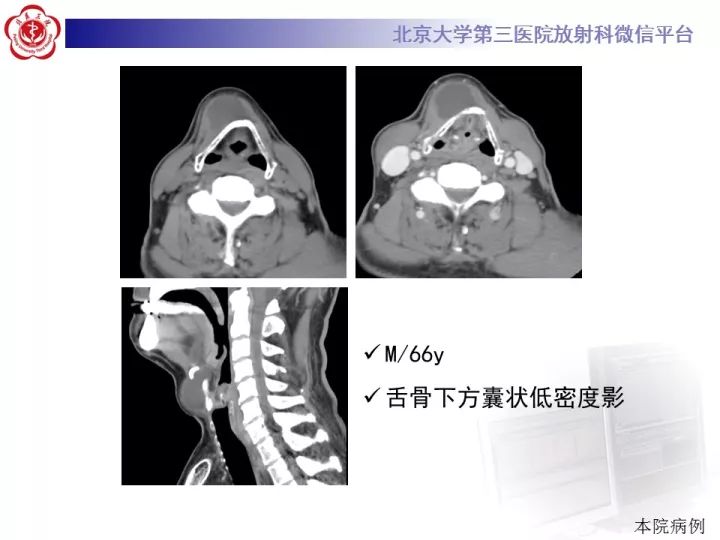 【病例】颈部囊性病例3例