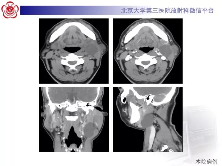 【病例】颈部囊性病例3例