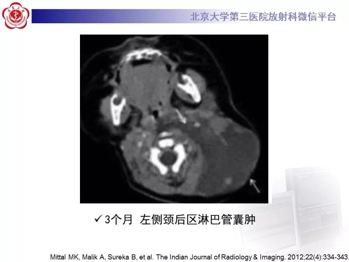 【病例】颈部囊性病例3例