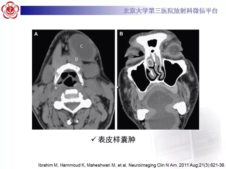 【病例】颈部囊性病例3例