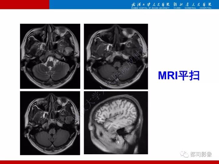 【病例】脊索样脑膜瘤1例MR影像诊断