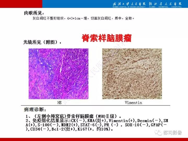 【病例】脊索样脑膜瘤1例MR影像诊断