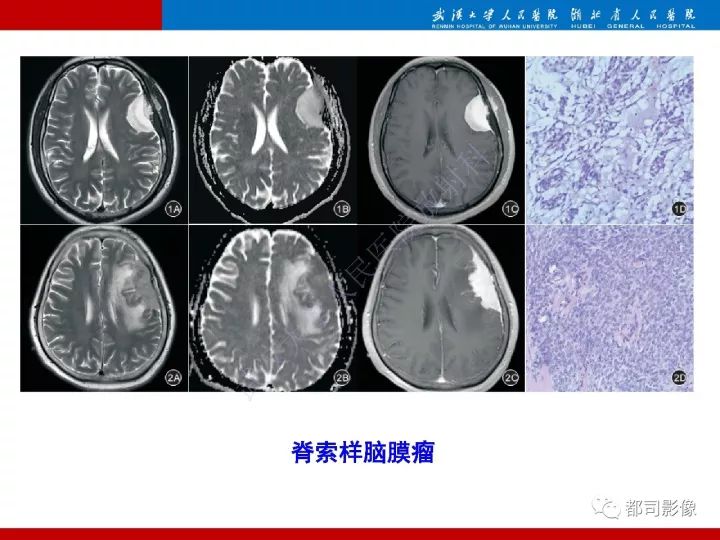 【病例】脊索样脑膜瘤1例MR影像诊断