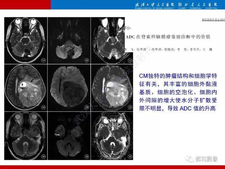 【病例】脊索样脑膜瘤1例MR影像诊断