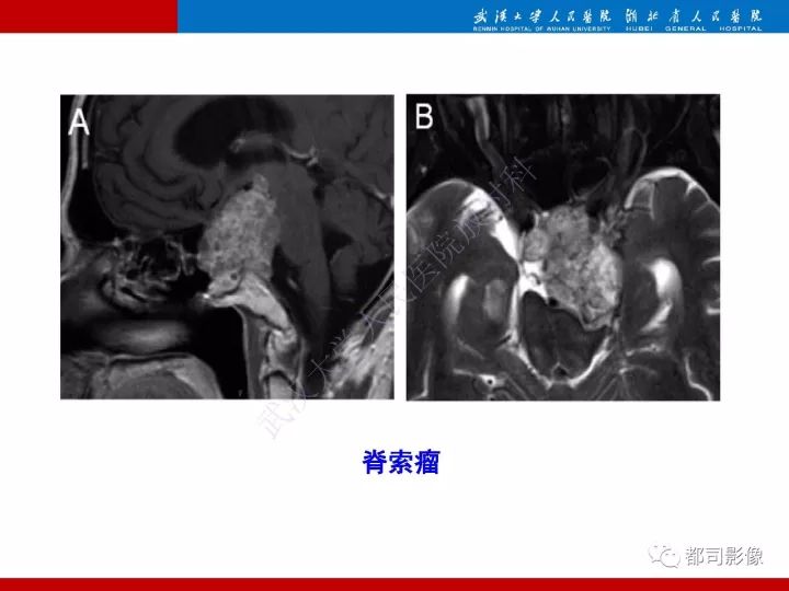 【病例】脊索样脑膜瘤1例MR影像诊断