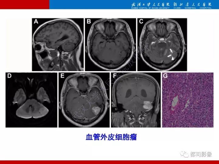 【病例】脊索样脑膜瘤1例MR影像诊断