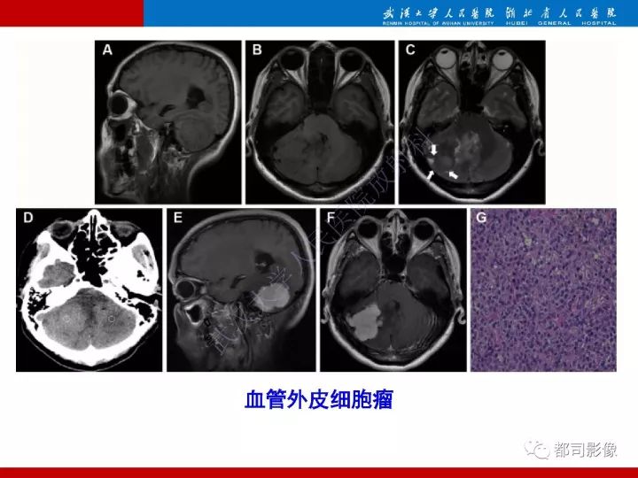 【病例】脊索样脑膜瘤1例MR影像诊断
