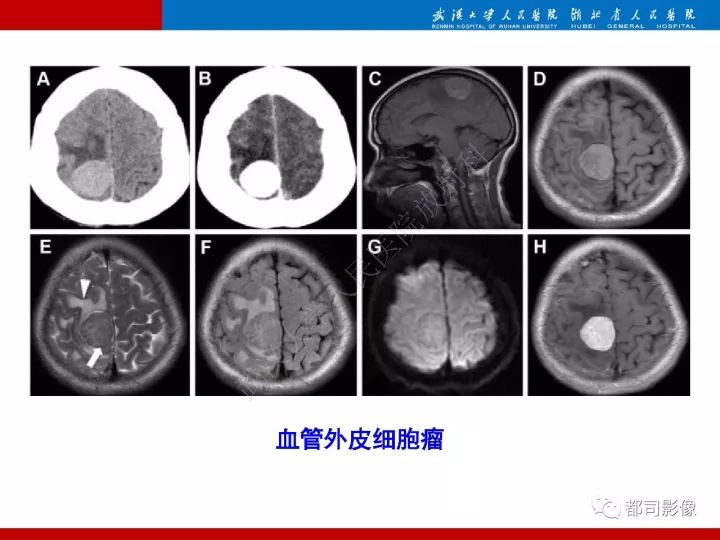 【病例】脊索样脑膜瘤1例MR影像诊断