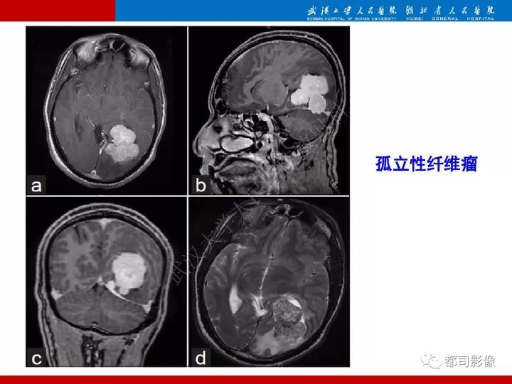【病例】脊索样脑膜瘤1例MR影像诊断