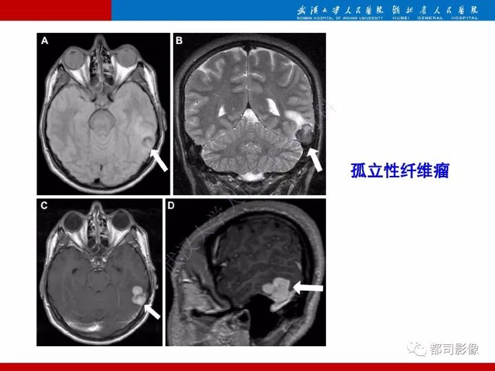【病例】脊索样脑膜瘤1例MR影像诊断