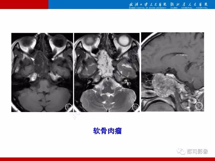 【病例】脊索样脑膜瘤1例MR影像诊断