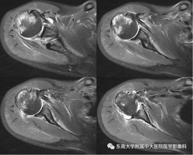 【病例】右肩关节损伤1例MR影像表现