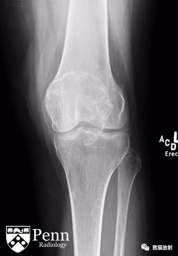 【双语病例】髌骨骨巨细胞瘤1例X线MR影像表现 【双语病例】髌骨骨巨细胞瘤1例X线MR影像表现