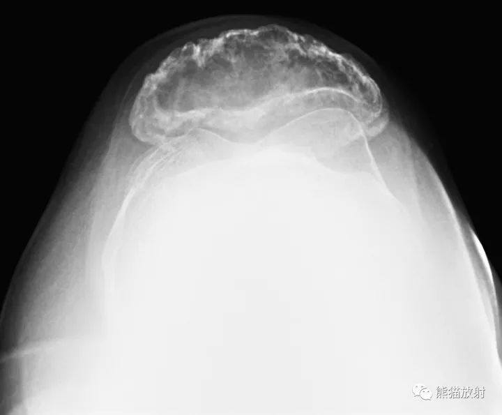 【双语病例】髌骨骨巨细胞瘤1例X线MR影像表现 【双语病例】髌骨骨巨细胞瘤1例X线MR影像表现