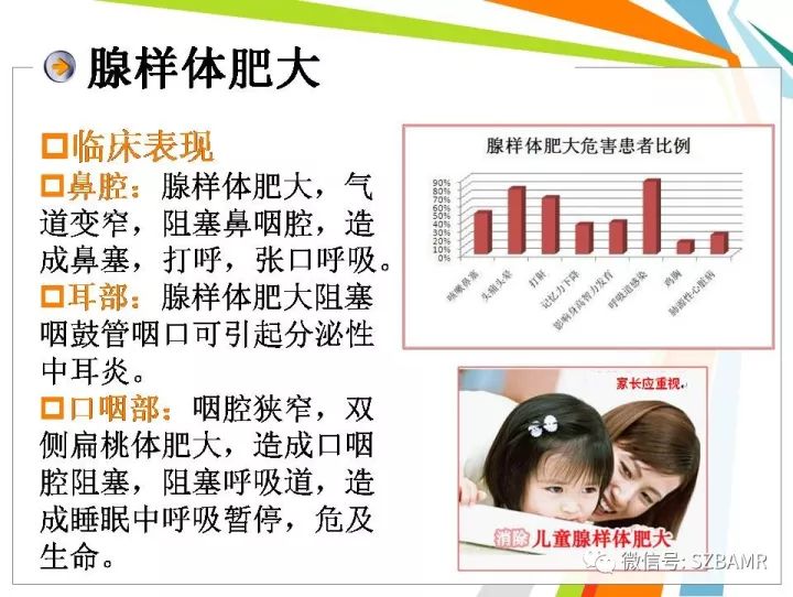 【PPT】腺样体肥大