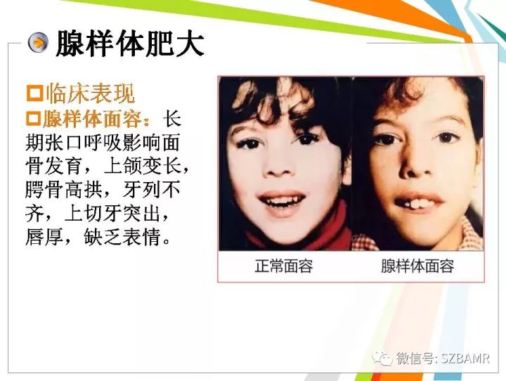 【PPT】腺样体肥大