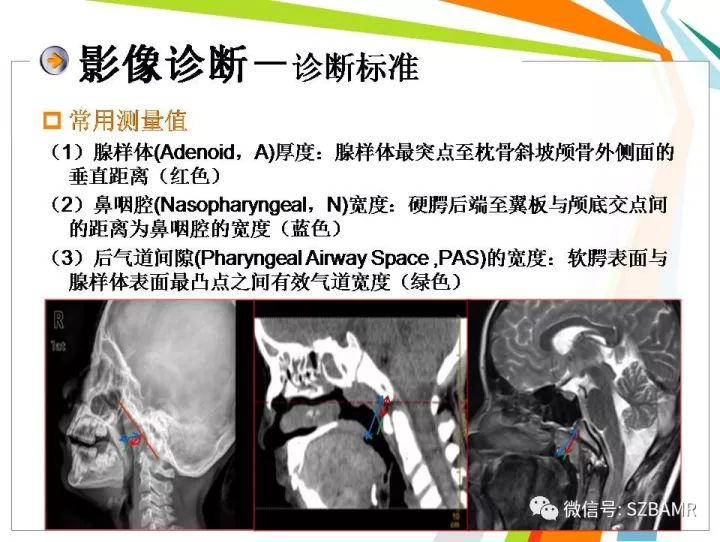 【PPT】腺样体肥大