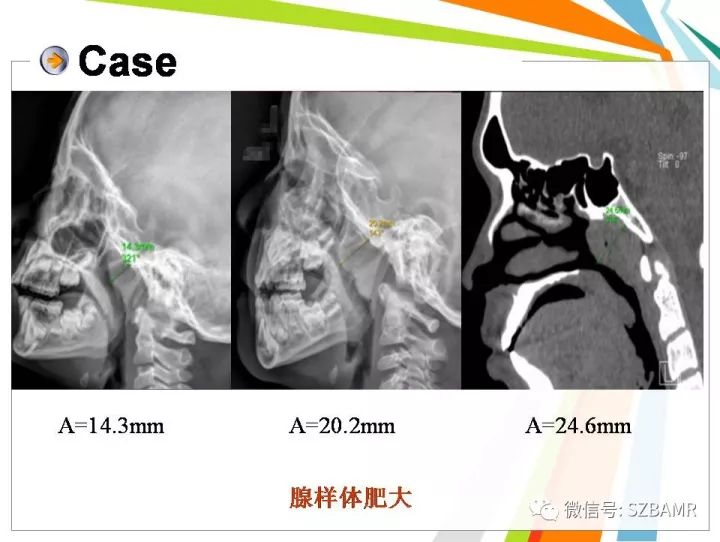 【PPT】腺样体肥大