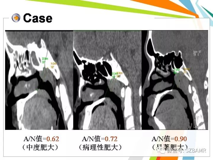 【PPT】腺样体肥大