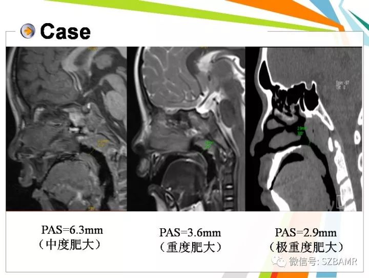 【PPT】腺样体肥大