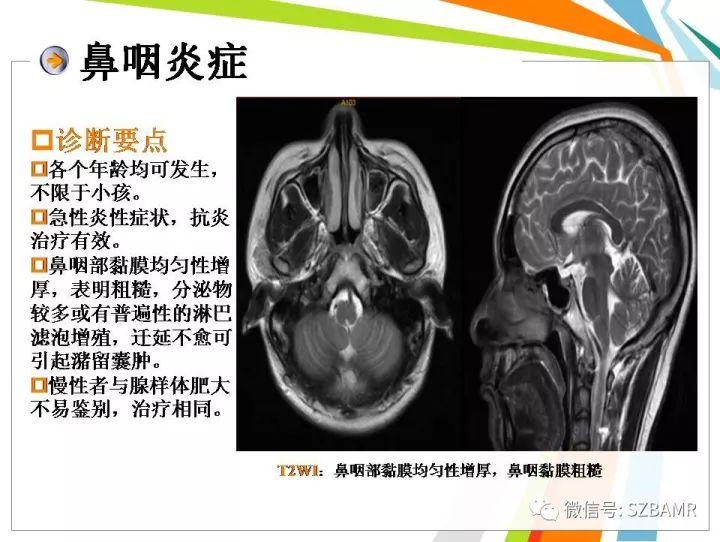 【PPT】腺样体肥大