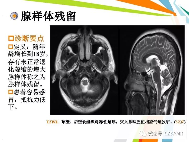 【PPT】腺样体肥大