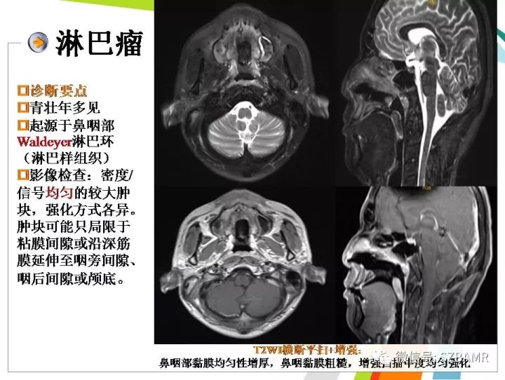 【PPT】腺样体肥大