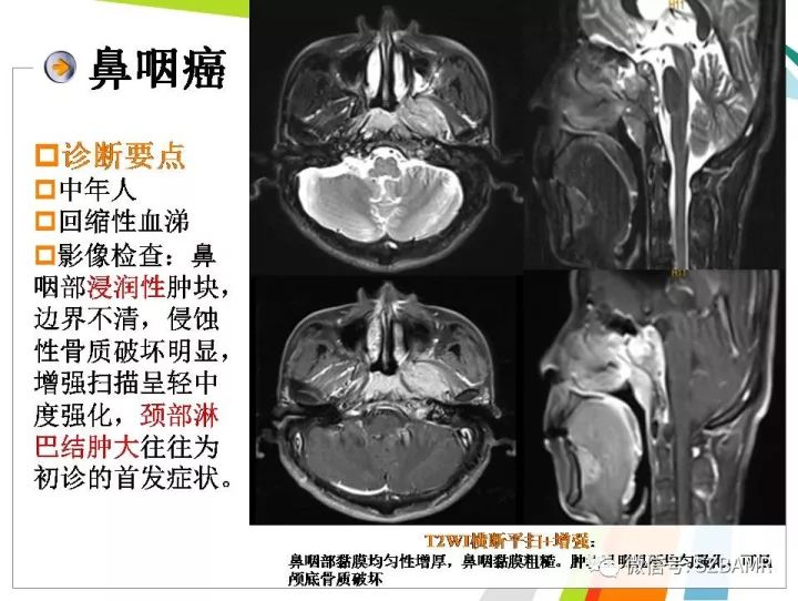 【PPT】腺样体肥大