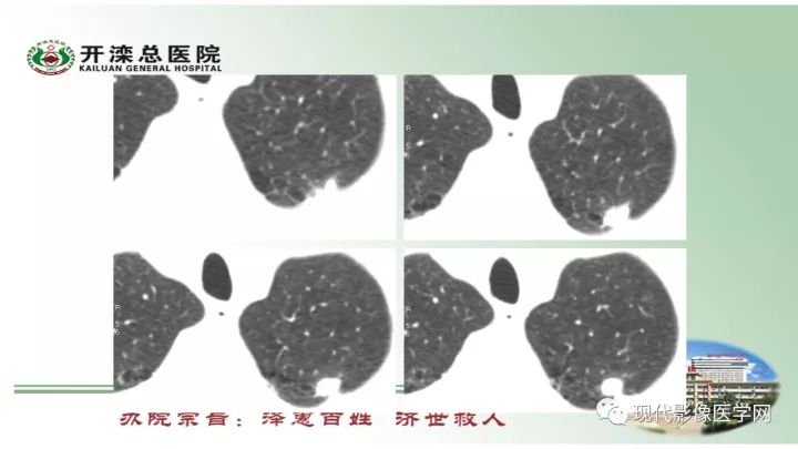 【病例】肺部结节病6例读片