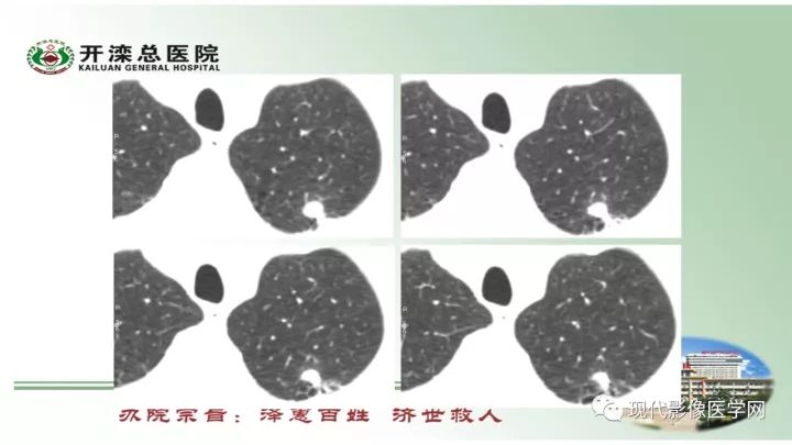 【病例】肺部结节病6例读片