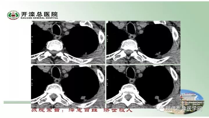 【病例】肺部结节病6例读片