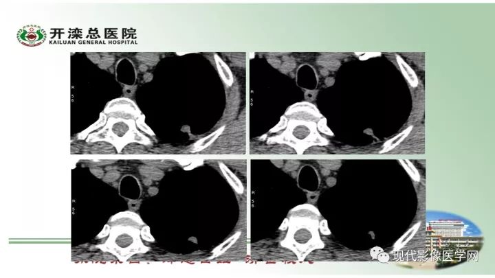 【病例】肺部结节病6例读片